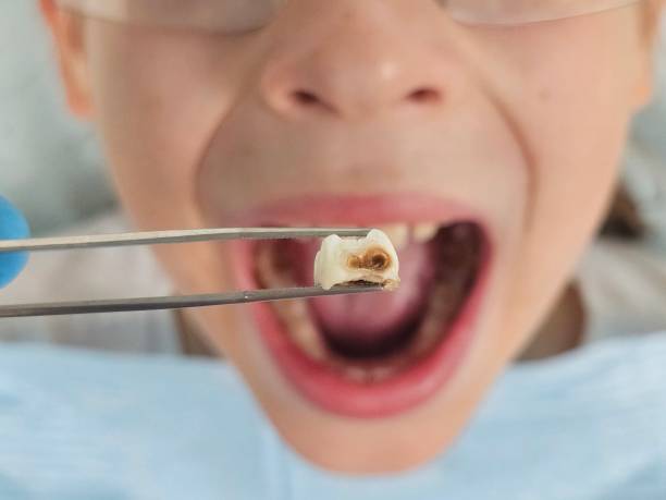 Best Emergency Tooth Extraction in Lewisville, NC